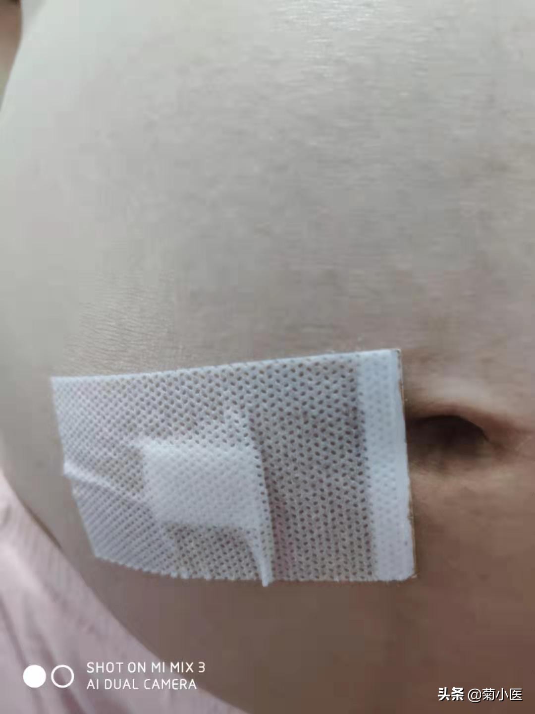 做了羊水穿刺一个星期,早期羊水穿刺