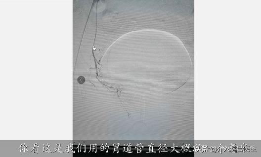 医生给你用图片讲解:前列腺增生如何微创治疗,一看就懂!