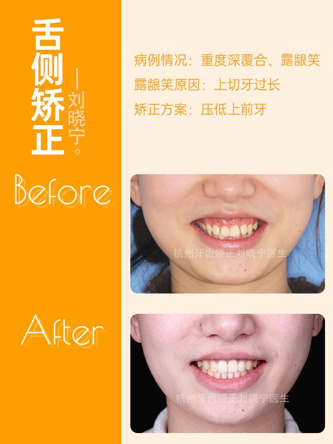 矫正牙齿如何改善露龈笑,矫正牙齿可以改善露龈笑吗