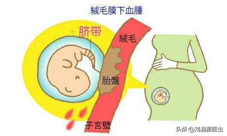 绒毛膜下血肿保胎的方法,免疫治疗不良妊娠的方法