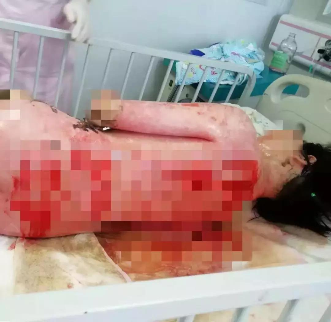 140余名儿童游泳后高烧,3岁小孩游泳后高烧不退