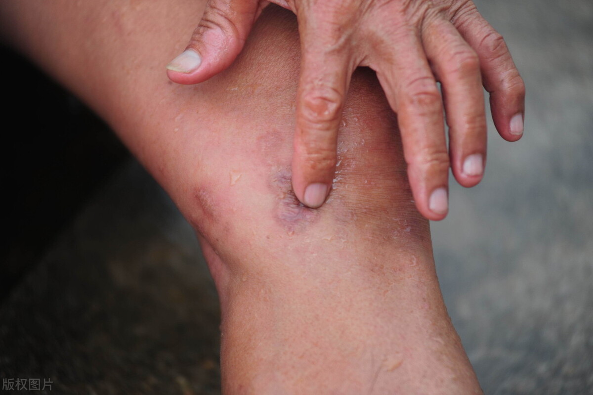 痛风不治而愈,中医治疗痛风消肿止痛最快方法