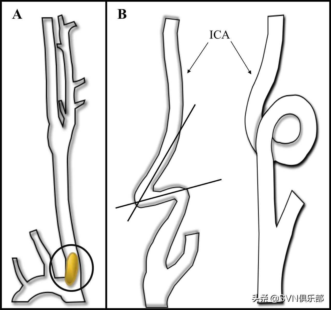 出版简讯｜直接颈动脉穿刺治疗急性缺血性卒中