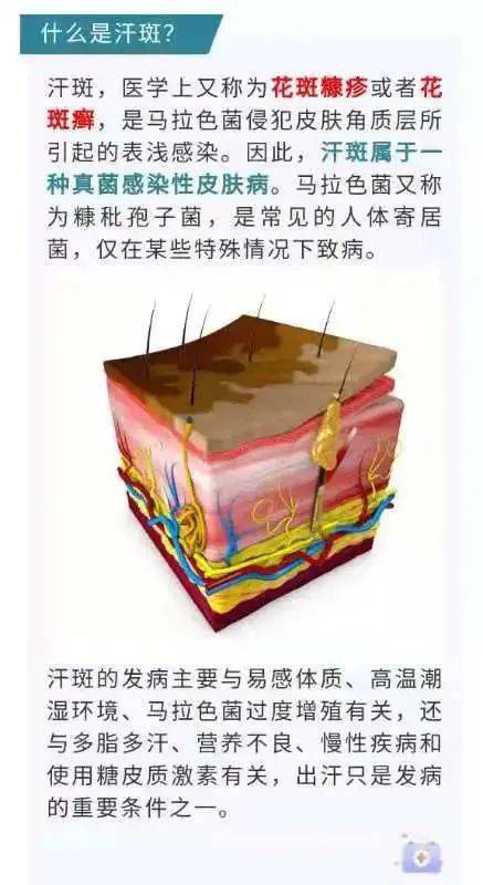 专家提醒夏季是汗斑高发的季节,夏天出汗斑怎么治疗