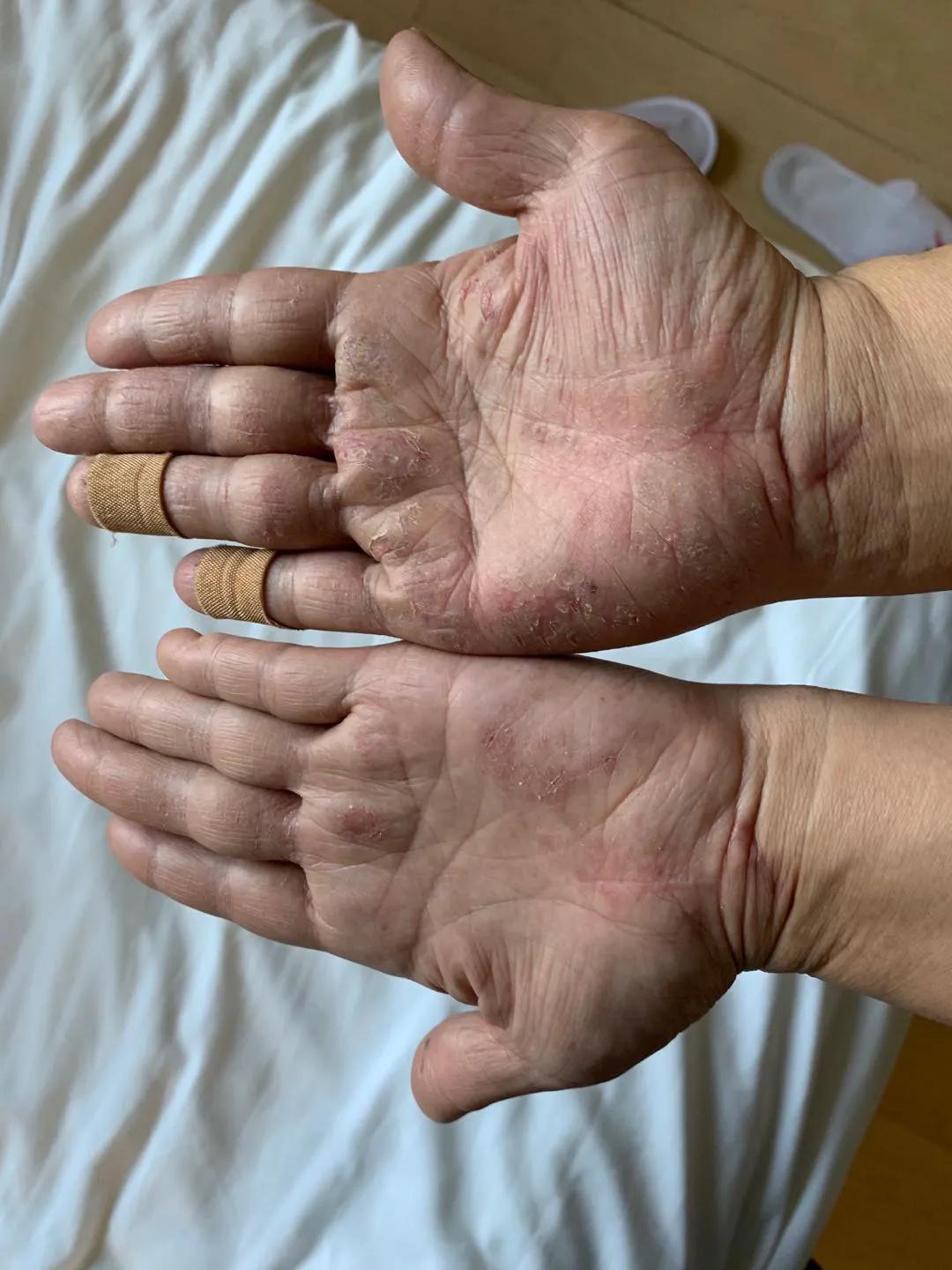 脚上和手上起水泡很痒怎么治,夏天起水泡很痒是什么原因