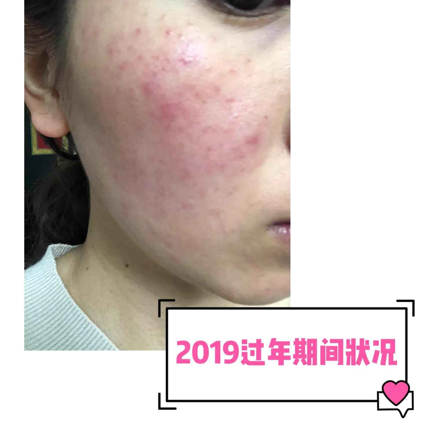 与病魔对抗的第30天,激素脸排毒第31天