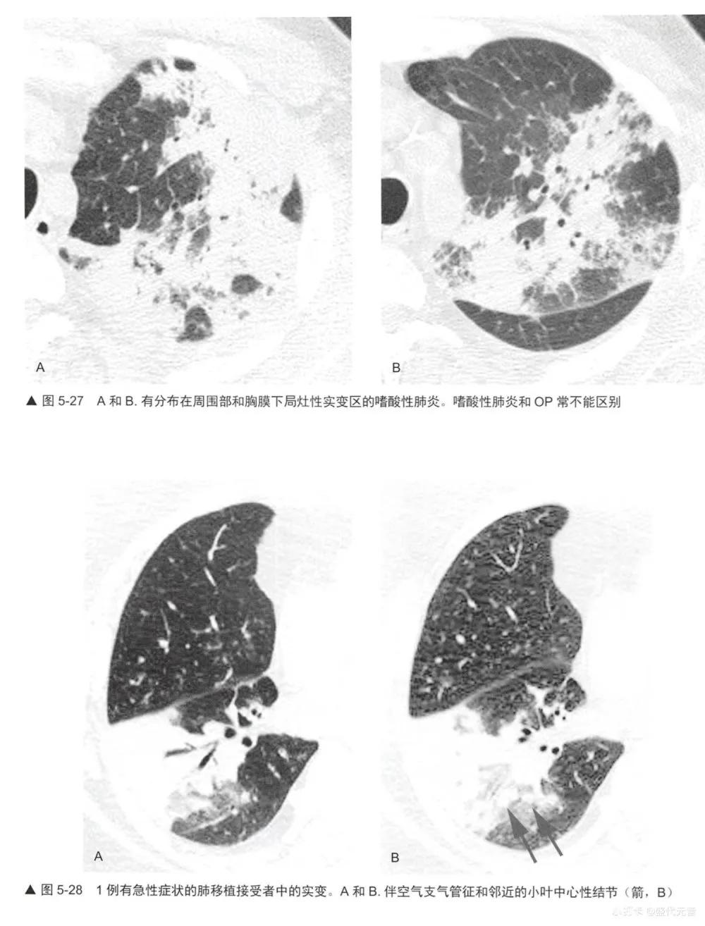 肺hrct诊断思路,肺部hrct检查呈阳性