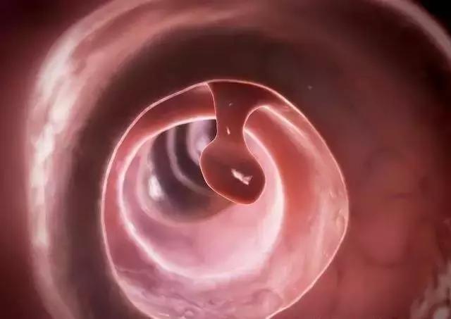 肠镜检查可以直接切除息肉吗,肠镜检查20多个息肉严重吗