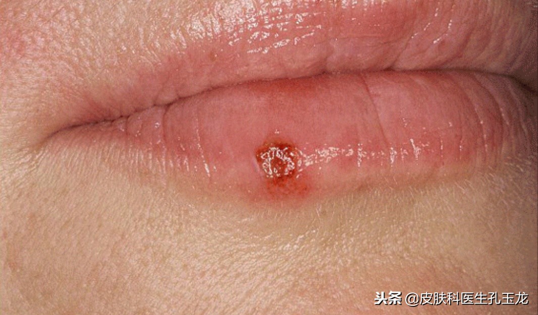 单纯疱疹和上火的区别,脸上的单纯疱疹是上火引起的吗