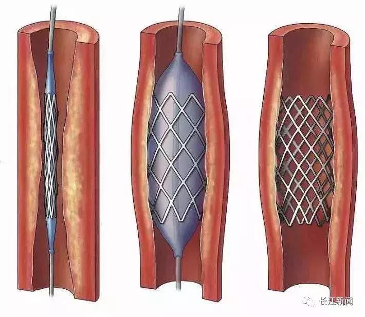 冠心病最可怕的疾病,冠心病致命的例子