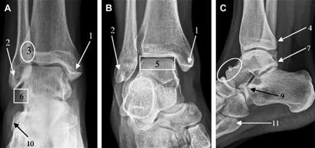值夜班急救措施,放射科容易漏诊的骨折