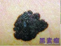 色素痣上有黑点是怎么回事,长色素痣要注意什么