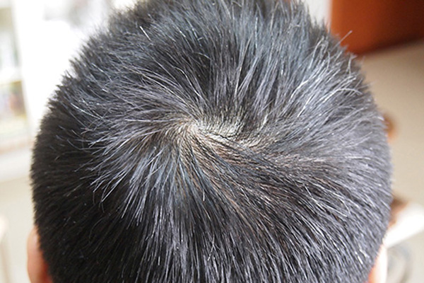 小孩少白头的治疗方法,小孩子少白头有什么妙招