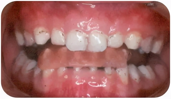 孩子嘴巴地包天有什么说法吗,小孩嘴地包天