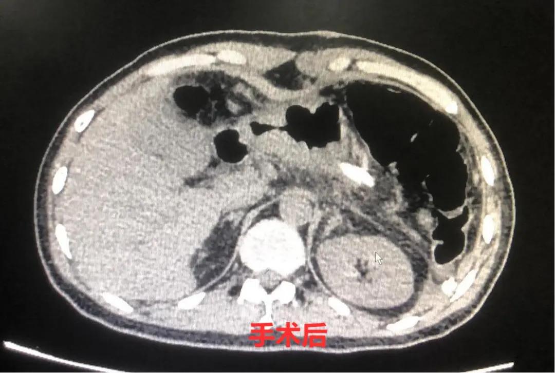 肝转移抗癌成功,万癌之王