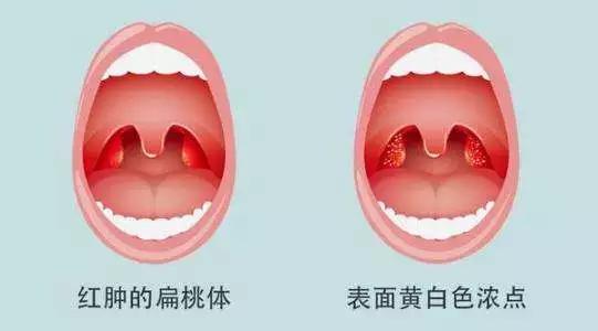 扁桃体反复发炎上火怎么办,上火导致的扁桃体发炎怎么弄