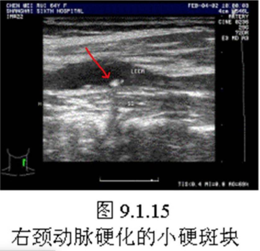 颈动脉有了斑块怎么办呀,颈动脉斑块引起耳鸣怎么办