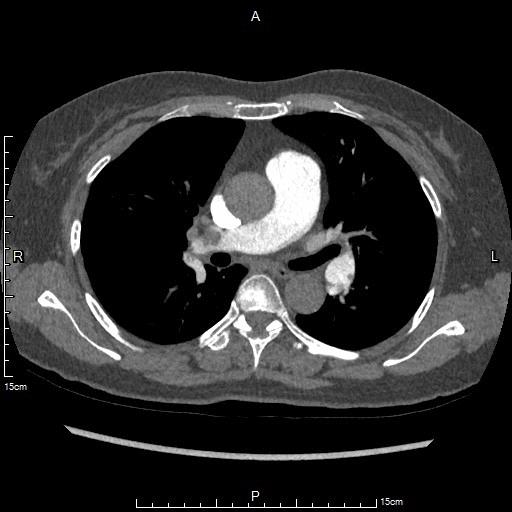 急性肺栓塞的中医操作,肺栓塞微创介入取栓