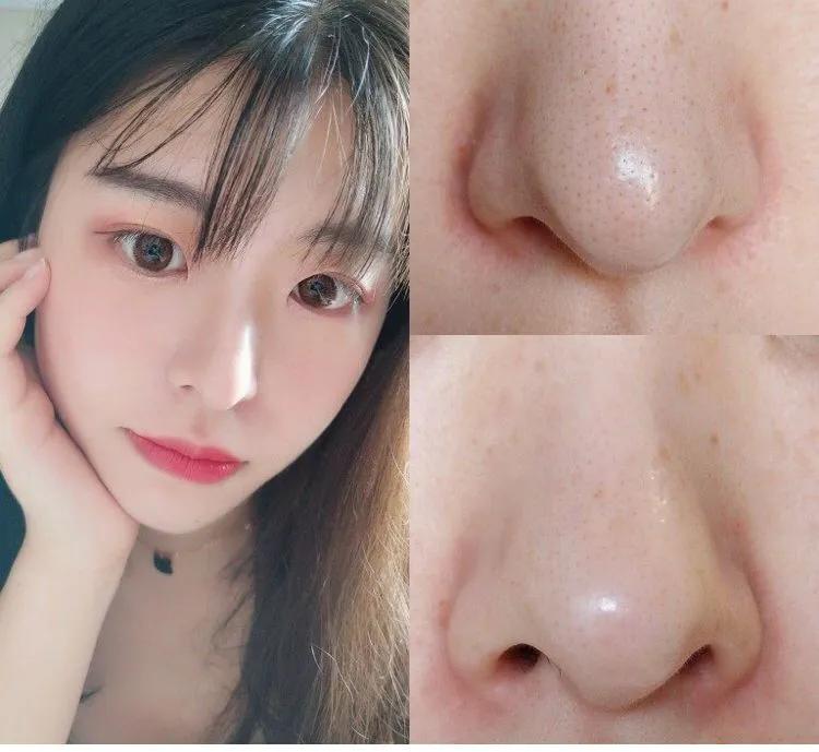 亲测真正有效去黑头粉刺产品,黑头连根拔起还会再长吗