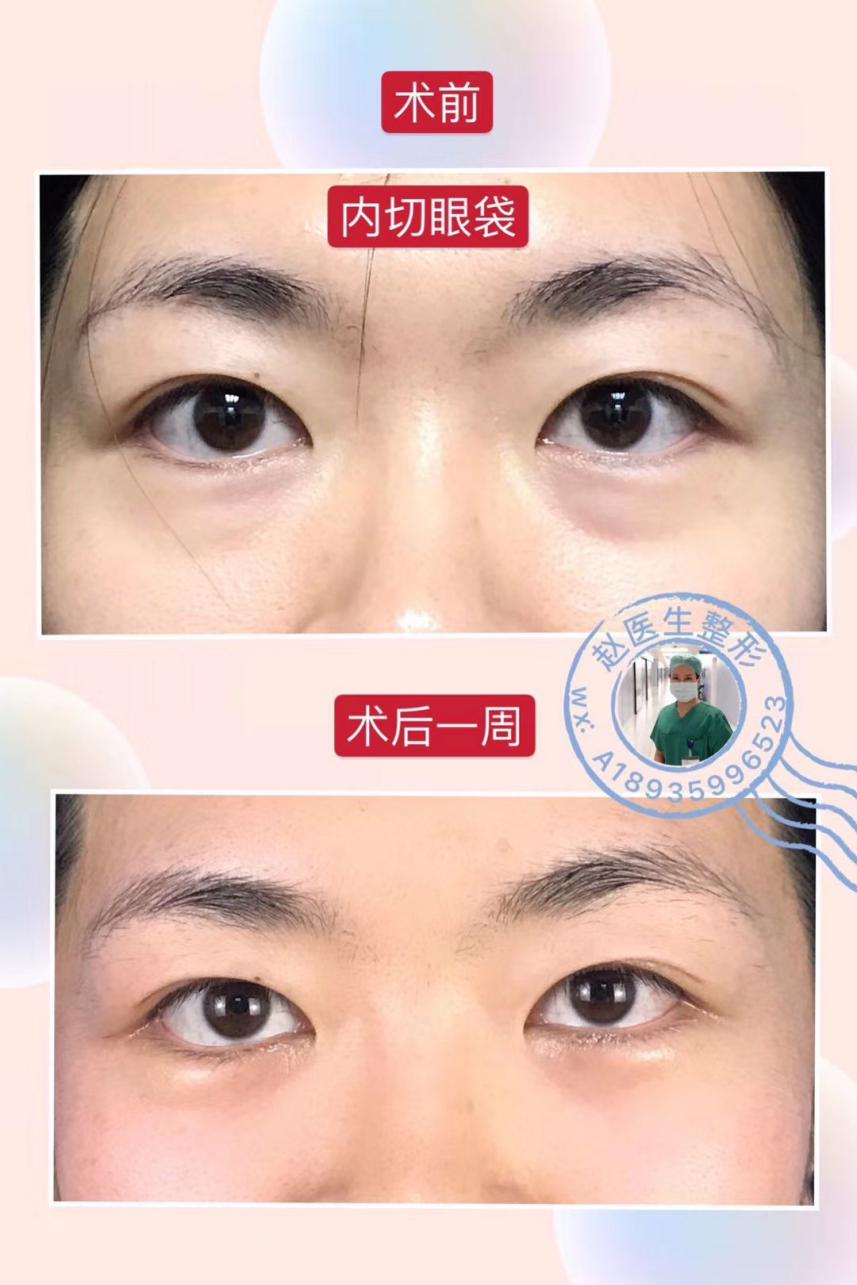 涂眼霜可以祛眼袋？不现实！祛眼袋的三种靠谱方法看这里