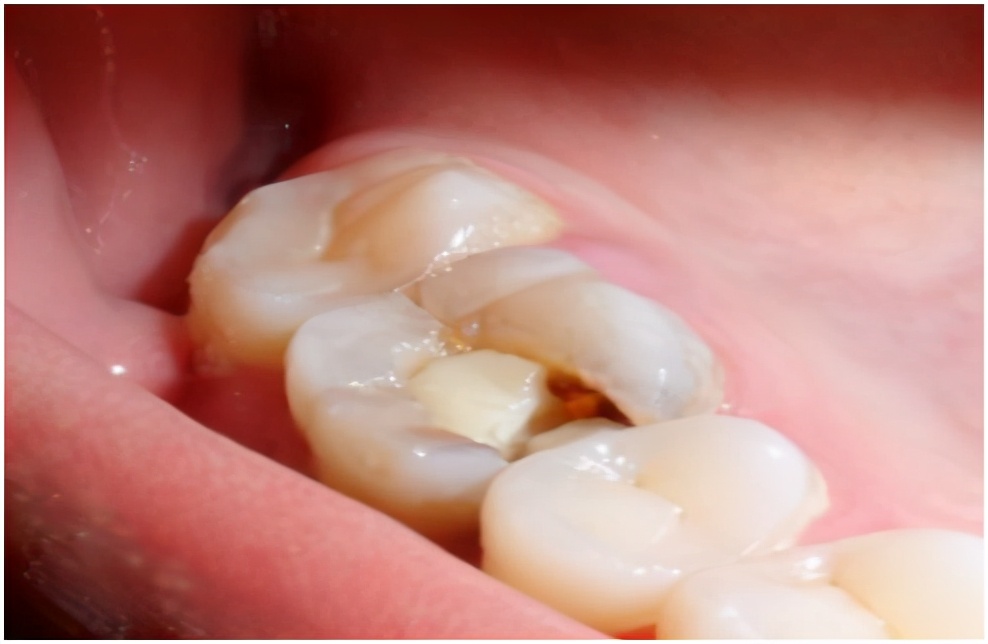 600补一颗牙齿贵吗,诊所补一颗牙多少钱