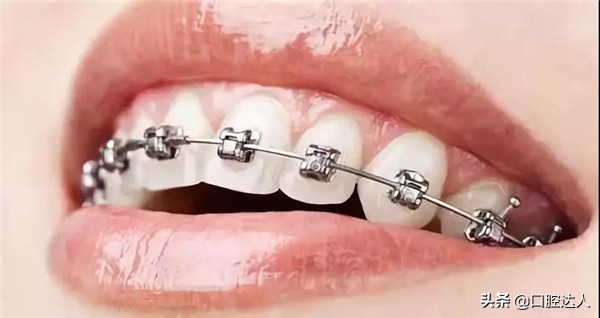 牙齿矫正的步骤,牙齿矫正怎么操作的