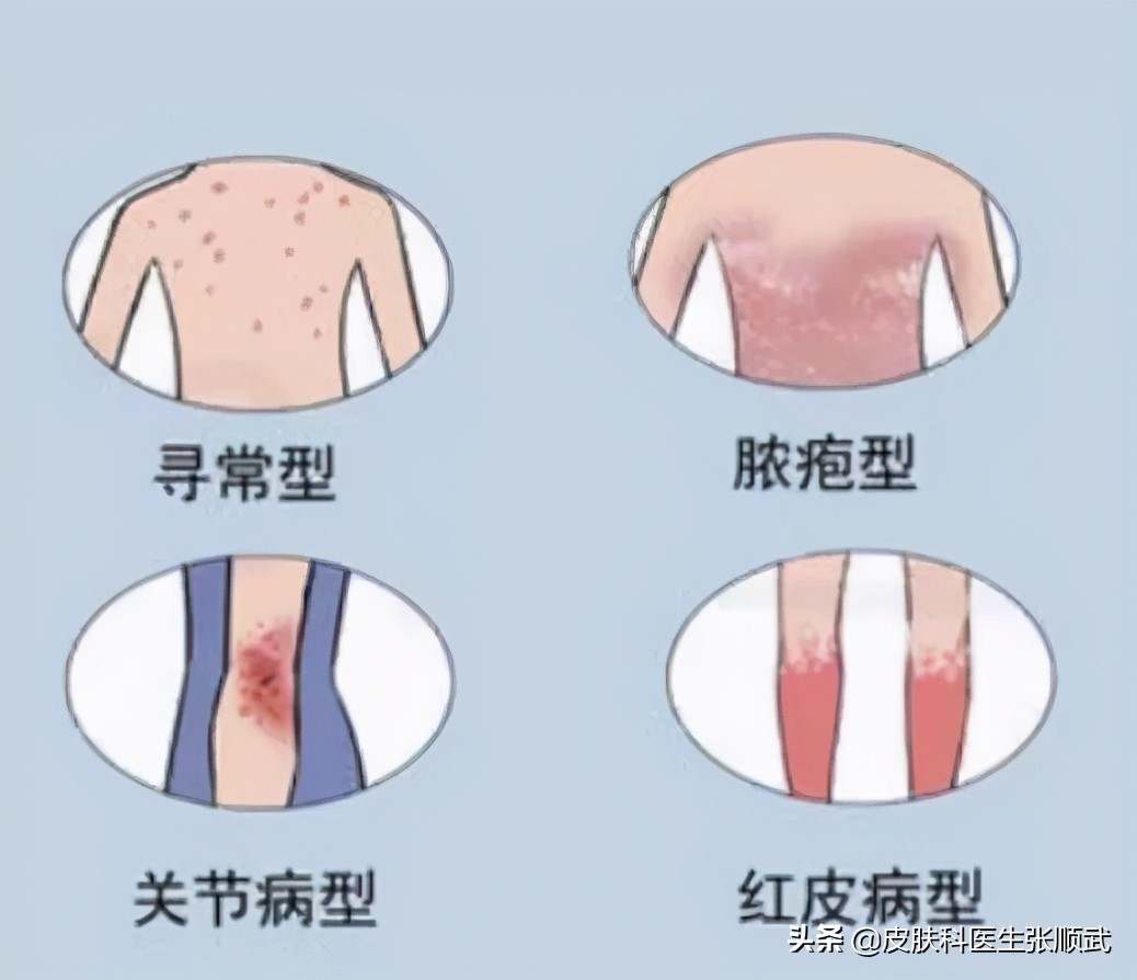 得了银屑病用什么药膏才能好,得了银屑病要预防什么