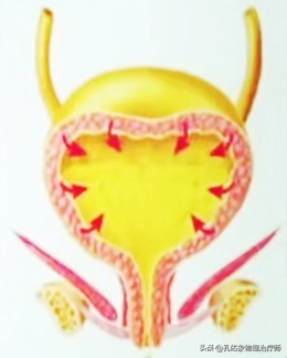 女性漏尿很严重是什么原因造成的,女性漏尿的原因及解决办法