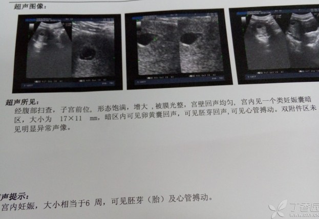 宫内早孕想终止妊娠，是选择手术流产，还是药物流产呢？