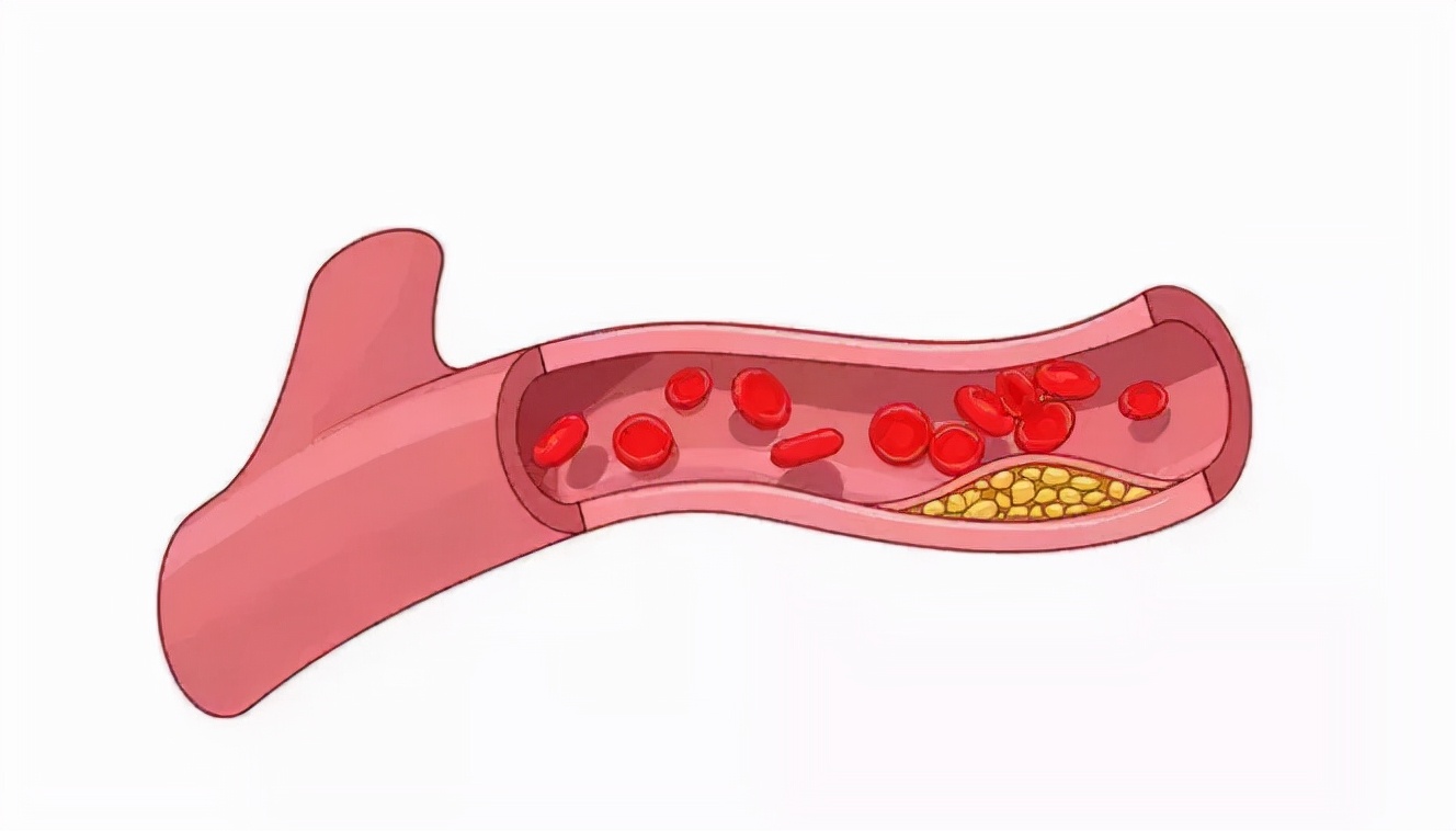 动脉斑块会掉下来吗？坦白说：不会！但导致斑块的危险因素要警惕