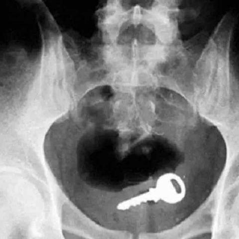 不作死就不会死，看看这些被人类搞进身体里的异物