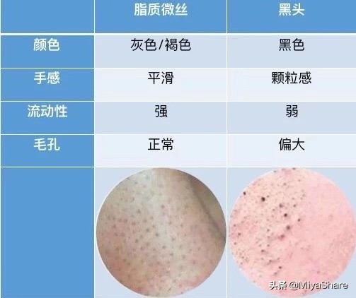 教你如何从根源解决黑头,反复黑头的原因和解决方法