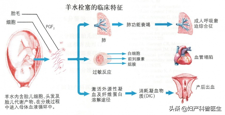 最吓人的羊水栓塞,羊水栓塞高发人群怎么避免