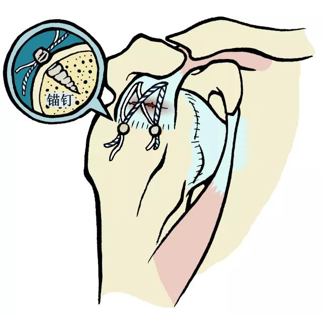 肩伤如何练肩,骨科专家教你肩袖康复训练