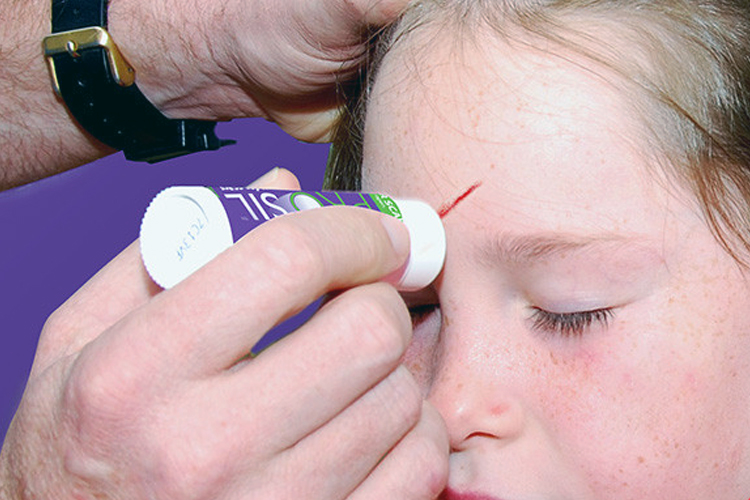 疤痕体质眼睛增生,眼角疤痕增生怎么解决