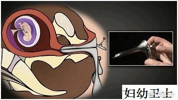 人流对生育影响有多大,人流不干净二次清宫影响怀孕吗