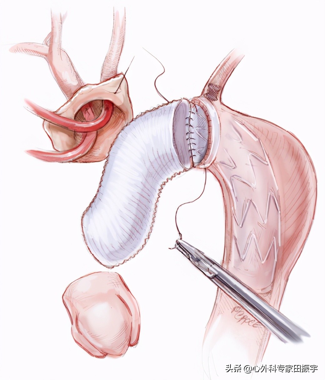 主动脉夹层破裂b型,急性主动脉夹层动脉瘤破裂