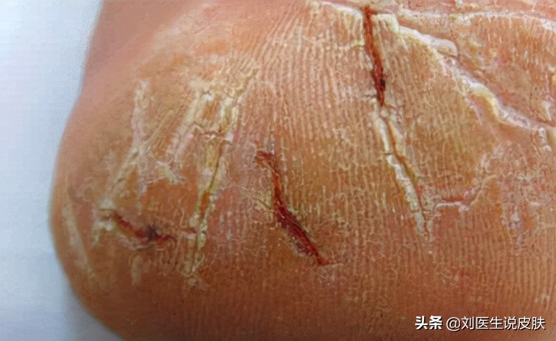 手脚皲裂如何除菌,秋冬季节手脚皲裂怎么办