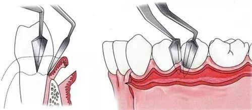 得了牙周炎的人最多能活多久,得了侵袭性牙周炎最多撑多久