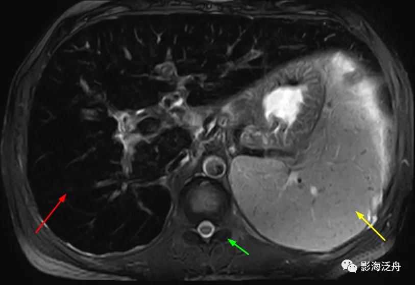 肝脏弥漫性病变严重吗,肝脏弥漫性的病变的症状