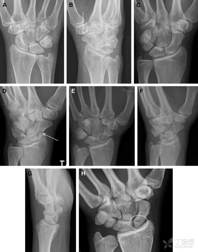 放射科夜班病例大全,放射科容易漏诊的骨折