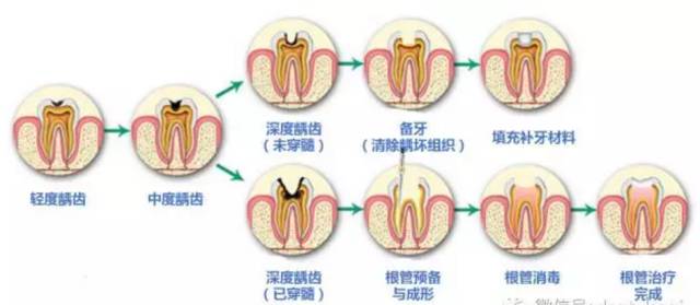 补牙最详细的过程来了，你还会看不懂吗？