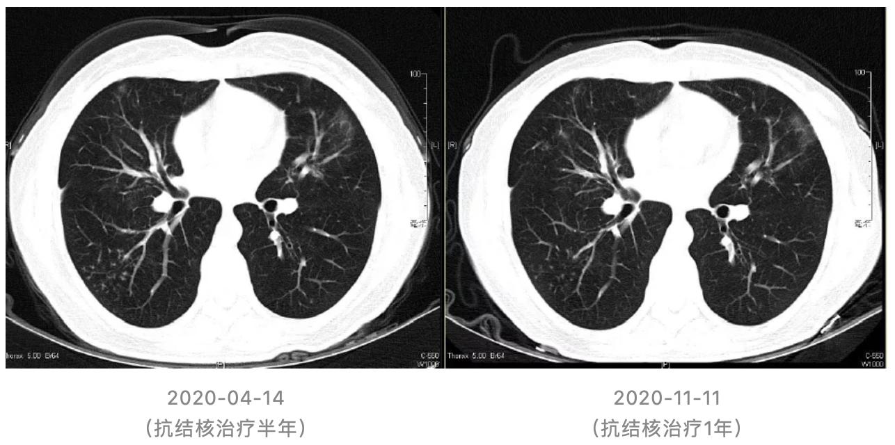 机化性肺炎必须病理确诊吗,机化性肺炎好转的征兆