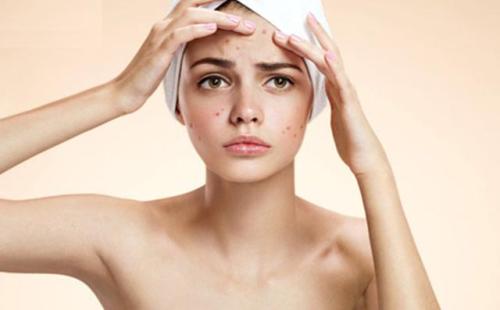 脸上各个部位长痘痘的原因图解,脸上不同的位置长痘痘什么原因