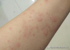 慢性荨麻疹治好了还需要忌口吗,麻疹怎么解释
