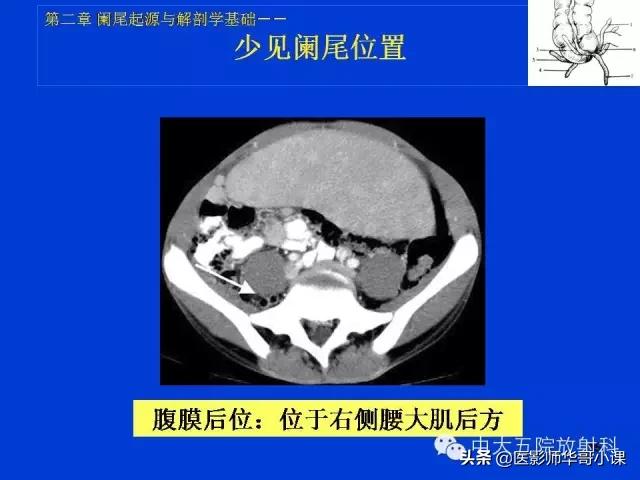 阑尾炎课件,阑尾炎的超声课件