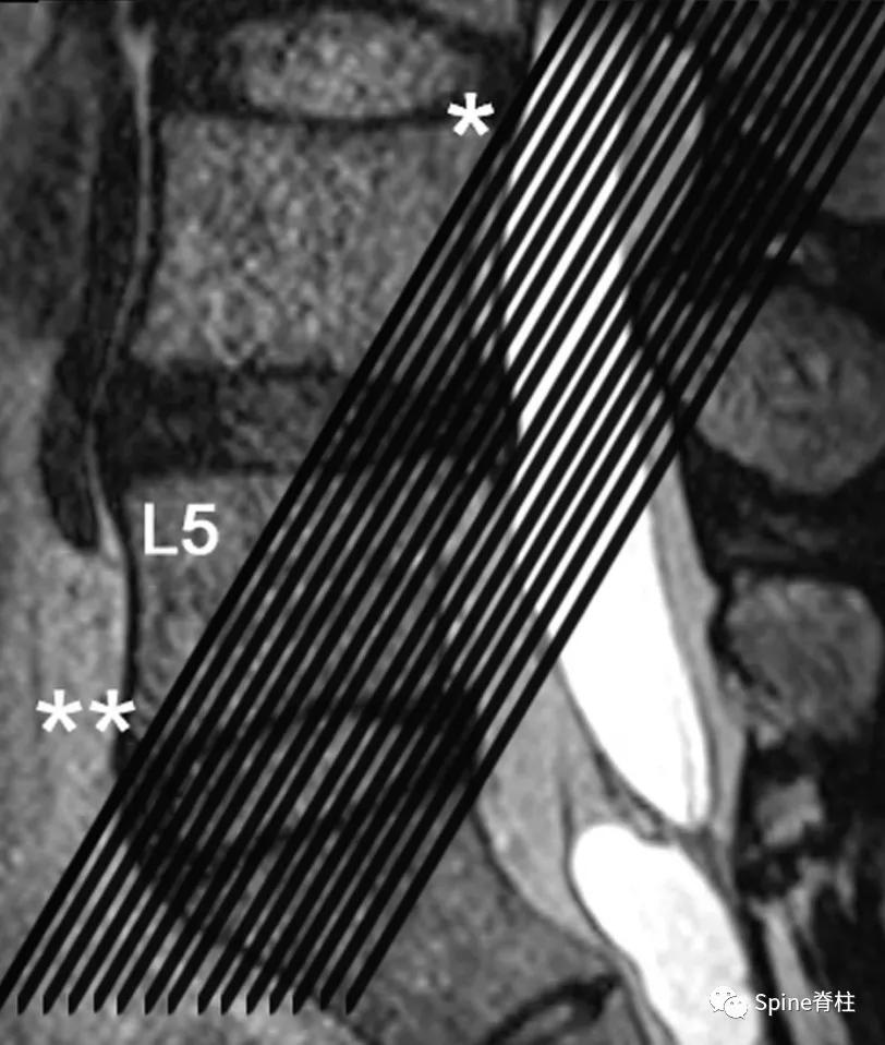 下肢疼痛是腰椎间盘突出引起的吗,下肢放射痛查不出原因