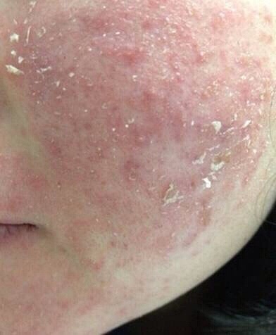 激素治疗过敏后遗症,断激素药有什么反应