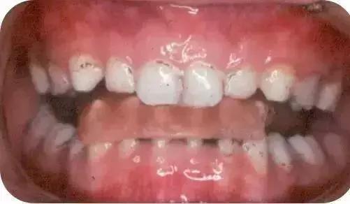 地包天早期矫正最佳时间,地包天10-15岁矫正是最佳年龄吗