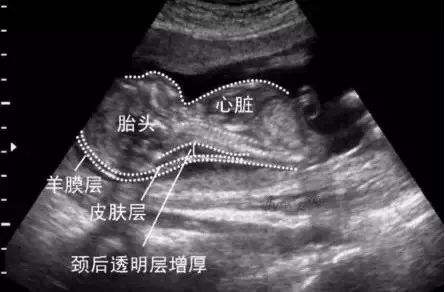 nt增厚胎儿一定会有问题吗,nt增厚的宝宝会不会很笨